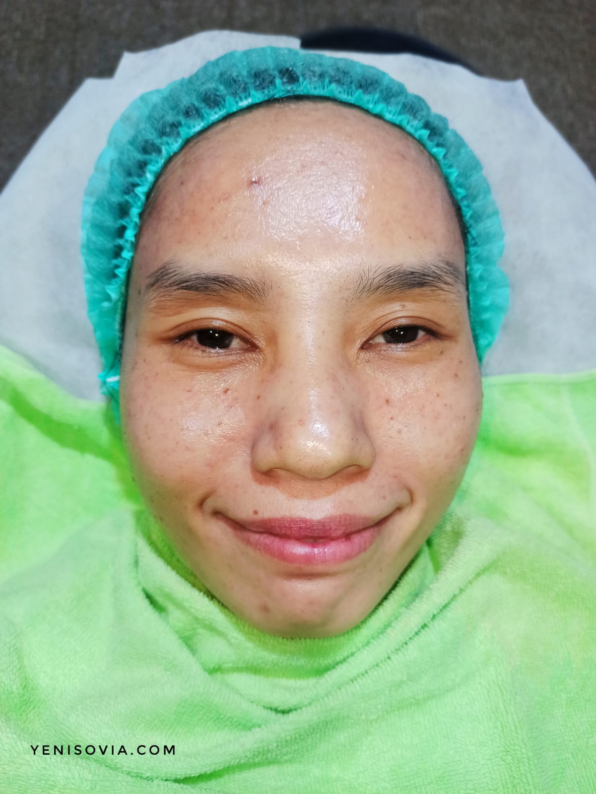 Pengalamanku Face PRP Treatment di ZAP Clinic Hasil treatment di ZAP Clinic